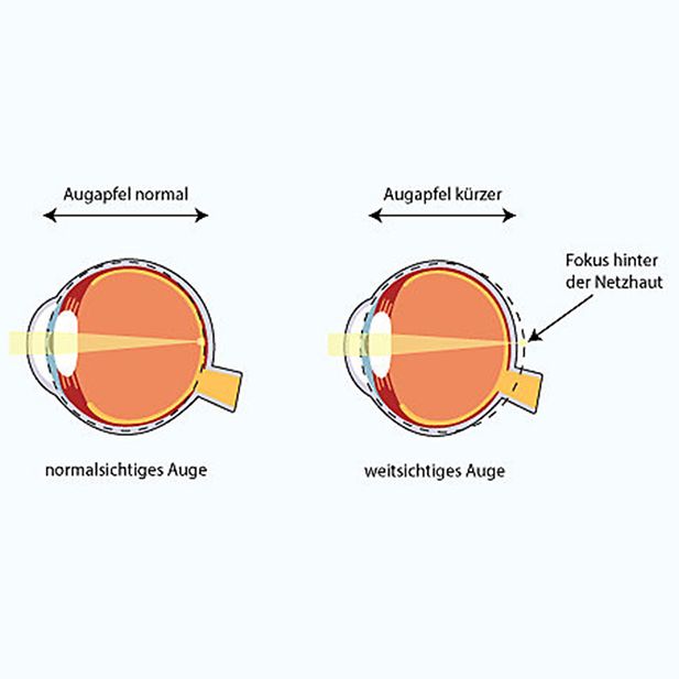 ww_farsightedness_and_lenses_row_3