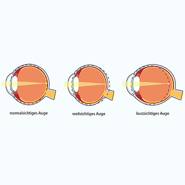 ww_farsightedness_and_lenses_row_6