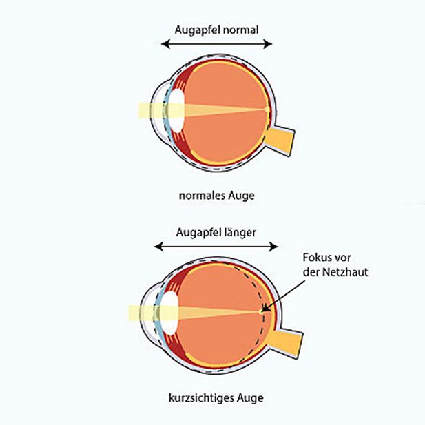 ww_myopia_and_lenses_row_3