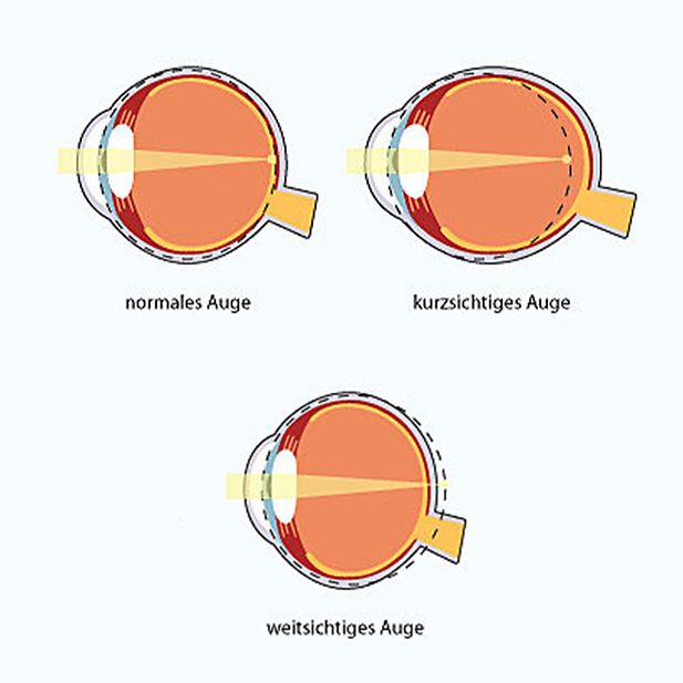 ww_myopia_and_lenses_row_6