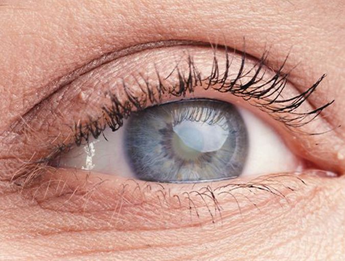 Gr ner Star Glaukom Lensbest