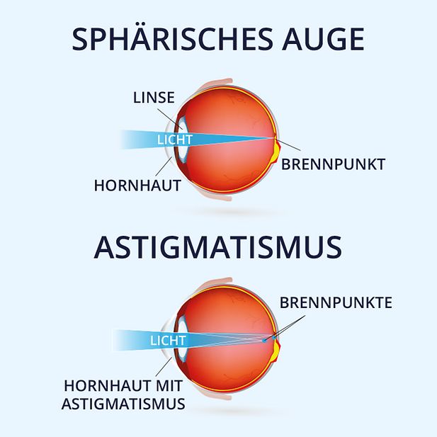 Illustration eines gesunden menschlichen Auges und eines Auges mit Hornhautverkrümmung