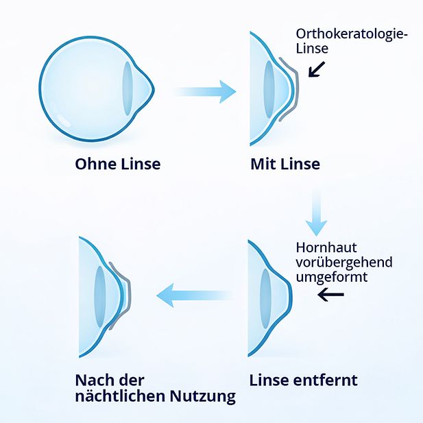 diagram of the shape of an eyeball before, during, and after an Ortho-k lens is used